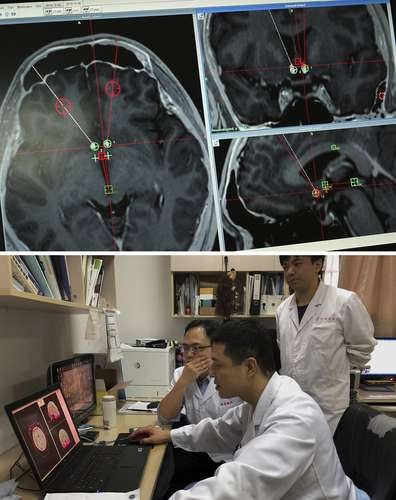 Cerebro de un adicto a las metanfetaminas, que recibe la terapia en el hospital Ruijin. Abajo, los médicos observan el órgano en una computadora.Foto Ap